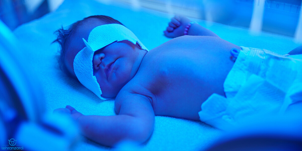 درمان زردی نوزاد نور به روش فتوتراپی