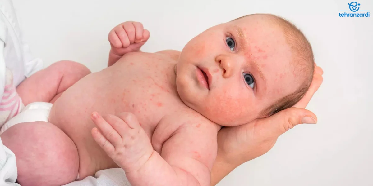 راش پوستی در نوزادان به علت مصرف فنوباربیتال